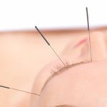 Plastic Surgery Healing. Acupuncture Benefits